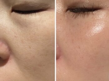 ミルジュ(MiLuJu)/マーメイドセルトリートメント