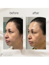 プリマベーラ 箕面店(Primavera)/エクソリフト