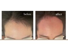 テンピスモ(tempismo)/before after