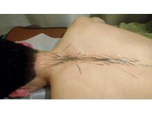 上野毛駅前整骨院 鍼灸院/自律神経への鍼