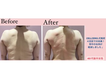 じぶんdeエステ 梅田店/CELLZERO.式 症例/背中/4回