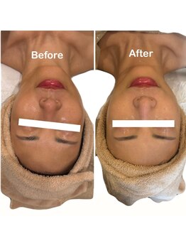 アールユー ギンザ(Ryou ginza)/ただの肌管理じゃなく小顔にも◎