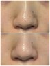 【黒ずみ毛穴×開き毛穴】根本ケア2回セット★人気の毛穴特化コース