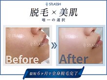 ストラッシュ 千葉店(STLASSH)/メニュー：全身脱毛（顔）