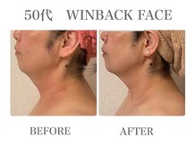 イリゼ(IRISER)の雰囲気(顎下、フェイスラインくっきり!リフトアップタイトニング♪)