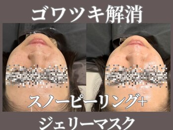 マヴィ 守口店(MavY.)/スノーピーリング