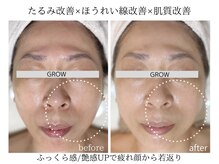 グロウ バイ フェイシャルデザイン アンド アイ(GROW)