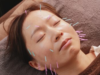 グリーン鍼灸整体院(green鍼灸整体院)/美容鍼