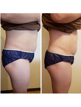 ロージーハピネス(Rosy happiness)/40代からの気になるお腹