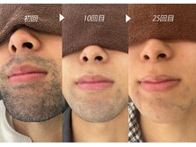 シャイニー/脱毛経過　初回/１０回/２５回