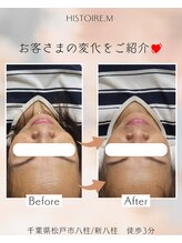 イストアールエム(HISTOIRE.M)/筋膜リリースヘッドスパ