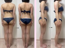 プラスワンビューティテン 新大阪店(Plus One Beauty)/ボディ/ハイパーナイフ/痩身