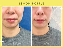 シロカネ 光の森店(SHIROKANE)/レモンボトル×小顔コルギ☆