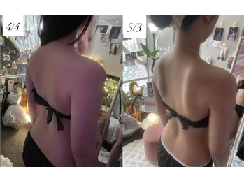 ビルーチェ(美LUCE)/Ａ様(26)1ヶ月-２kgと後ろ姿変化