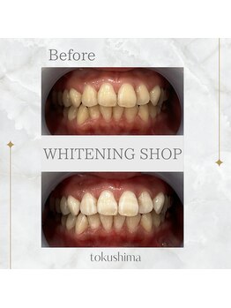 ホワイトニングショップ 徳島店/セルフホワイトニング1回の効果