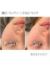 モイ(moi.)/◆Wピーリング◆