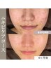 【顔ハーブピーリング各種】1ヶ月以内の再来店の方限定★《10%OFF》