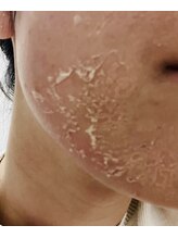 ブリリアンス(BRILLIANCE)/☆5daysホームケア期間中☆