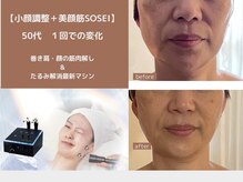 巻き肩・食い縛りの筋肉を解してからのマシンは更にリフトアップ