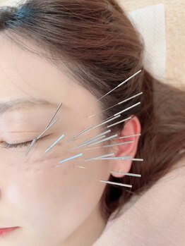 鍼灸施術を受けたい