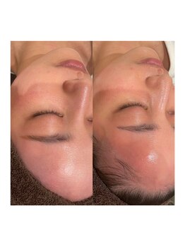 シカホワイトニングトウキョウ 笹塚店(CICA Whitening Tokyo)/REVIハーブピーリング