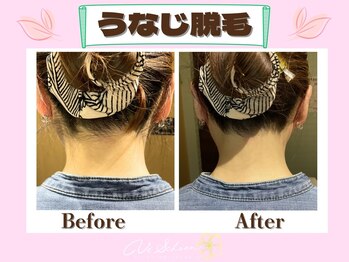 ヴィ シェーン(Vi Schoen)/うなじBefore/After 【U型】