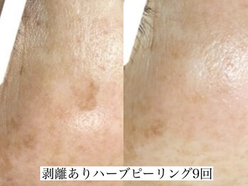 アリス(ALICE)/ハーブピーリングでシミ撲滅