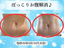 プリランティア 新宿店/お腹周りの脂肪冷却