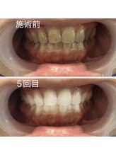 スマイルホワイト/20代女性