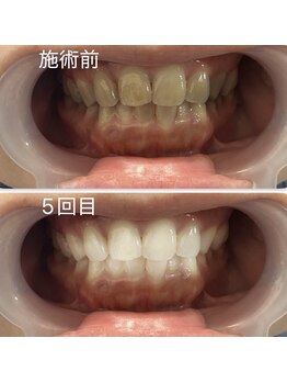 スマイルホワイト/20代女性