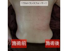 キアラ(CHIARA)/ウルトランスフォーマー痩身