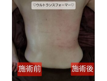 キアラ(CHIARA)/ウルトランスフォーマー痩身