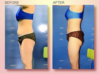 ジュリア オージェ 四条河原町店/ビフォーアフター（脂肪/サーモ)