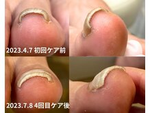 ポドウオーク(PODO WALK)/巻き爪　B/Sスパンゲ