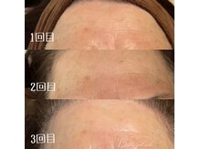 ベルアイラッシュ(Belleyelash)/【フェイシャルワックス】