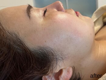 サロン ド エメ(salon de aimer)/【After】透明感、艶潤いアップ