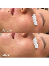 イリマレイサロン(iLima Lei SALON)/鎮静美肌トリートメント