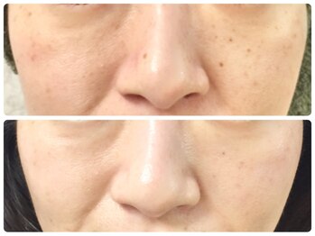 ラウン 京都(ROUN')/８回の施術ビフォーアフター