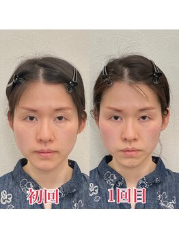 小顔22 ボルティ 赤坂支店(Bolty)/30代：小顔シンメトリー（1回）