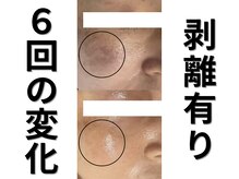 モニ 福岡(Moni)の雰囲気（ハーブピーリング 専門店 歴12年オーナー厳選ハーブを贅沢に使用）
