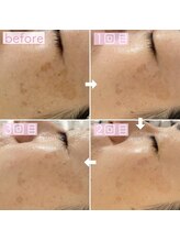 ペルラペティーユ(PERLA PETILLER)/水素ケア＋ビタミンC,A導入