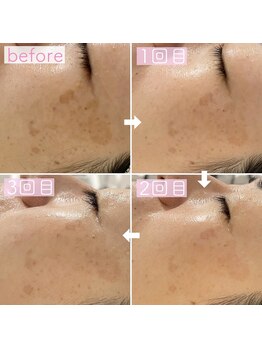 ペルラペティーユ(PERLA PETILLER)/水素ケア＋ビタミンC,A導入