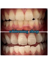 ホワイトニングショップ 武蔵小杉店/【BeforeAfter】2回 施術後比較