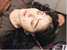 ナイン整体院/新宿駅近くで美容鍼