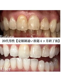 ホワイト 福岡博多店(WHITE)/ホワイトニングビフォーアフター