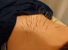 上野毛駅前整骨院 鍼灸院/腰痛への鍼