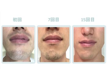 シンプル 中野(Simple)/人気のヒゲ脱毛