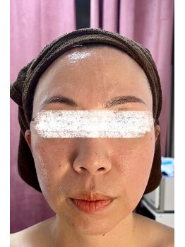 ラビ(RABBI)/40代女性　小顔矯正　左アフター