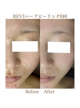 エステサロン ヴリエ 立川店/ハーブピーリング★6回結果