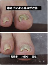 巻き爪じゅん 千葉駅前店/巻き爪による痛みが改善！